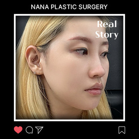 이현희님의 민트실리프팅, 안면윤곽 후기