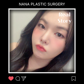 김지은님의 미니리프팅 후기