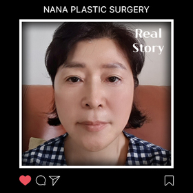 허경이님의 안면거상 후기
