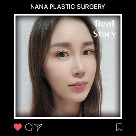 김성수님의 미니리프팅 후기