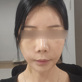 최인숙님의 포니테일 리프팅 후기