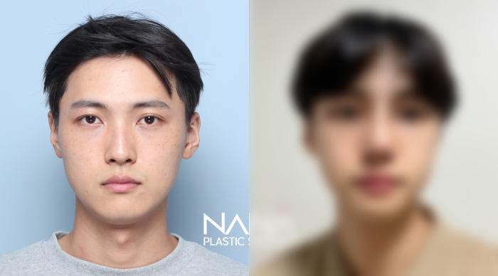 전후사진 전후사진