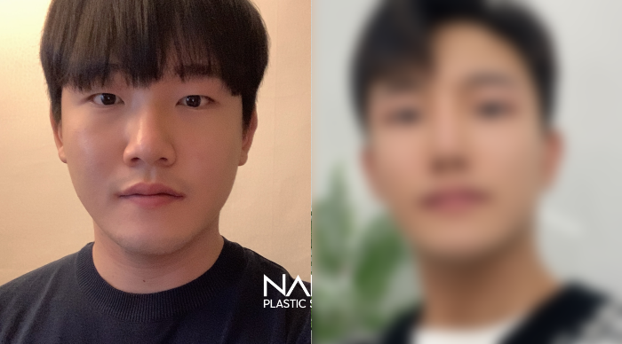 남자성형 전후사진 — 전후사진