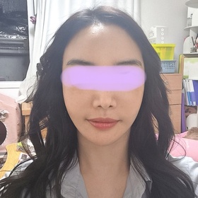 안나의일기님의 안면거상 후기