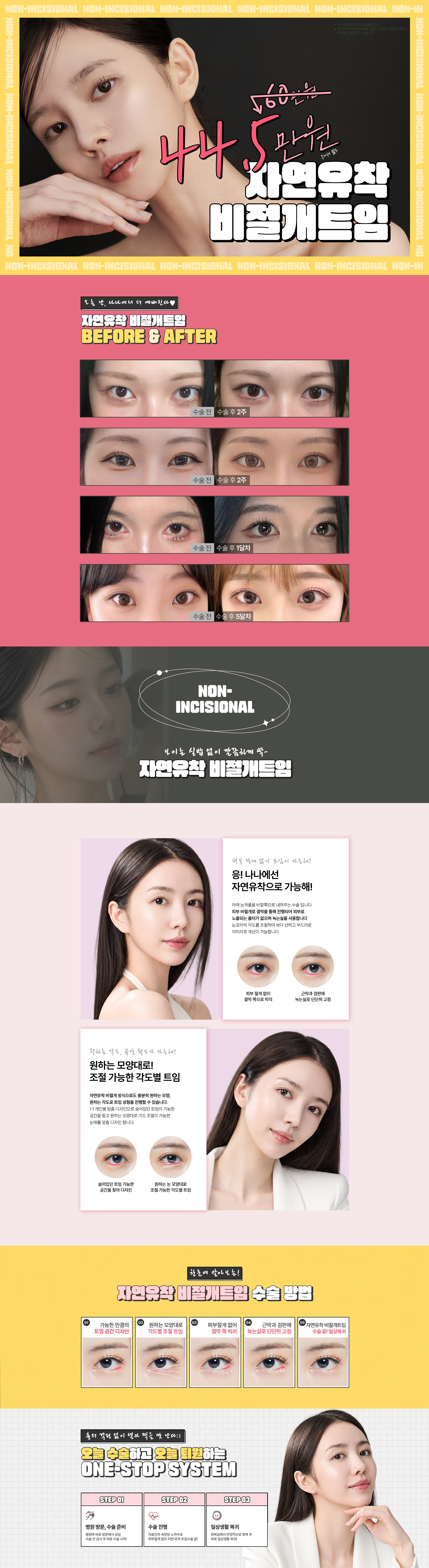 자연유착 비절개 트임 1