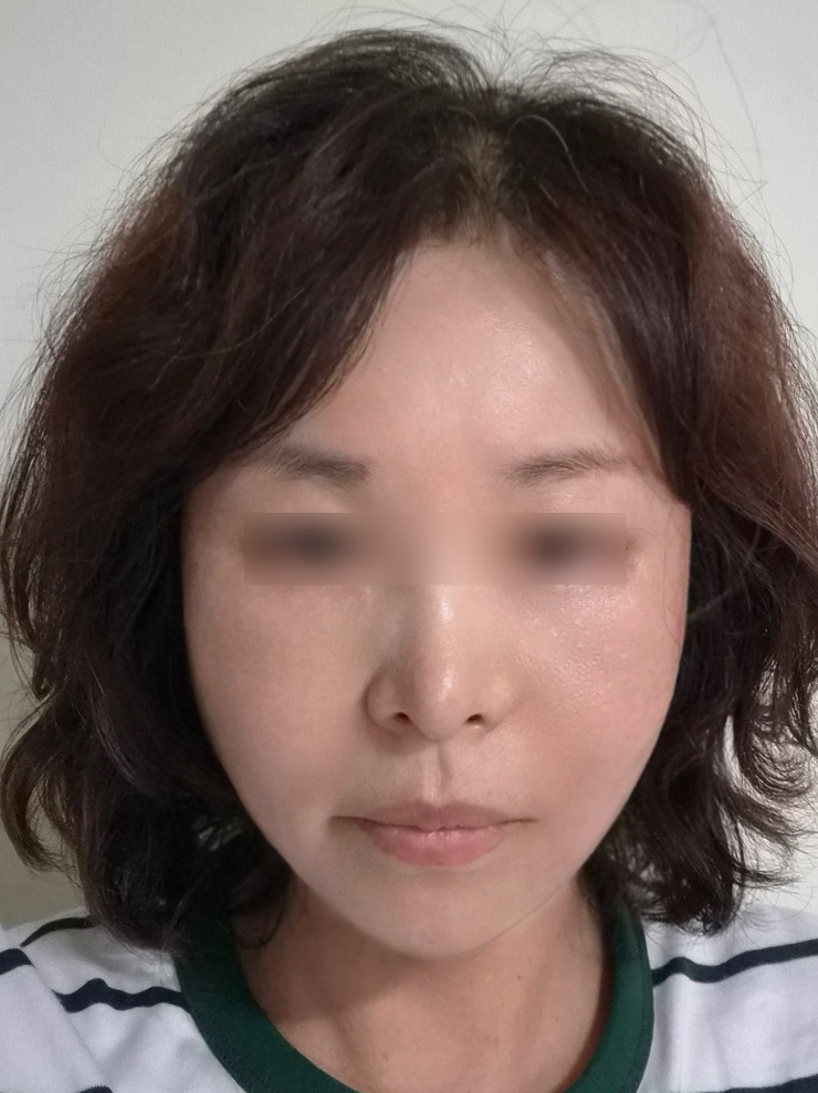 안면거상 후기