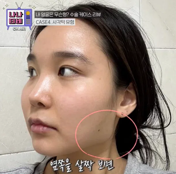 韓国整形　輪郭整形　輪郭3点　韓国美容外科