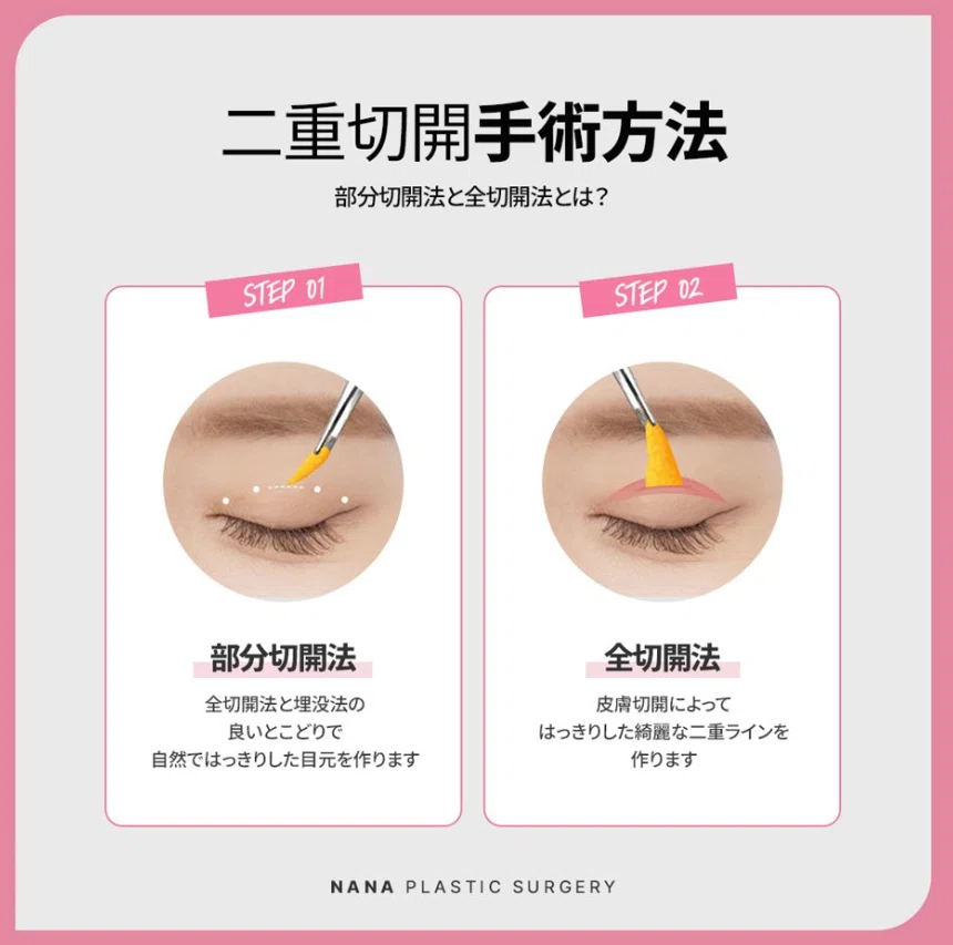 韓国整形　二重整形　埋没　目頭切開　目整形