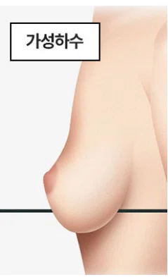 韓国整形 豊胸 谷間 バストアップ 垂れ乳