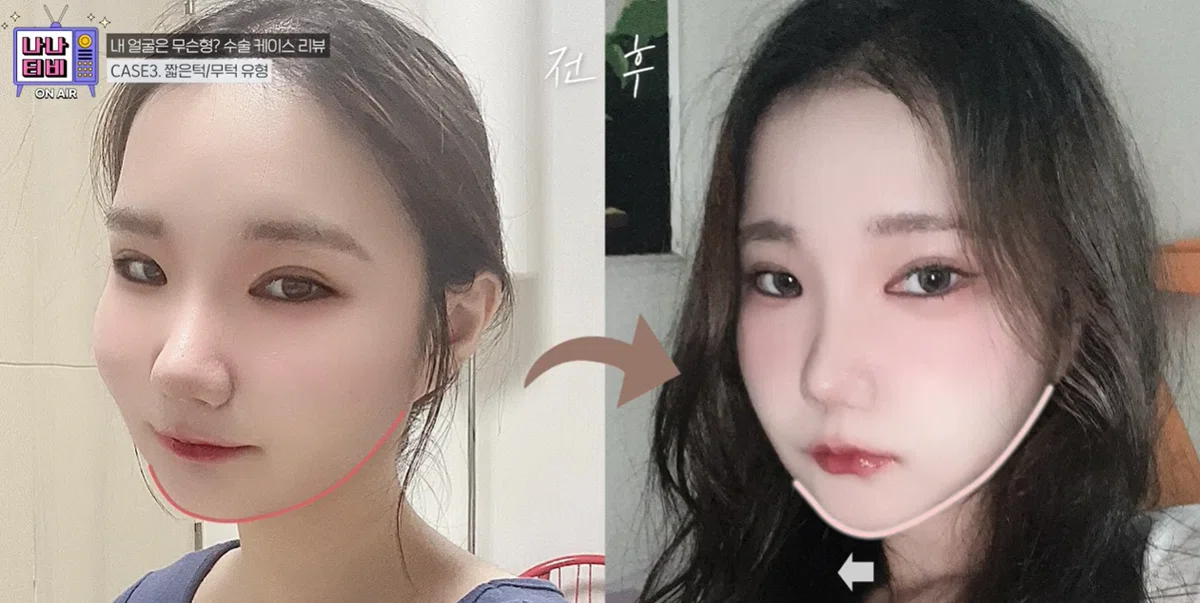韓国整形　輪郭整形　輪郭3点　韓国美容外科