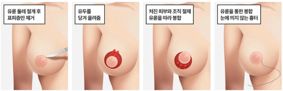 韓国整形 豊胸 谷間 バストアップ 垂れ乳