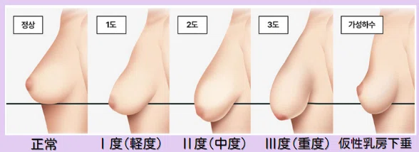 韓国整形 豊胸 谷間 バストアップ 垂れ乳
