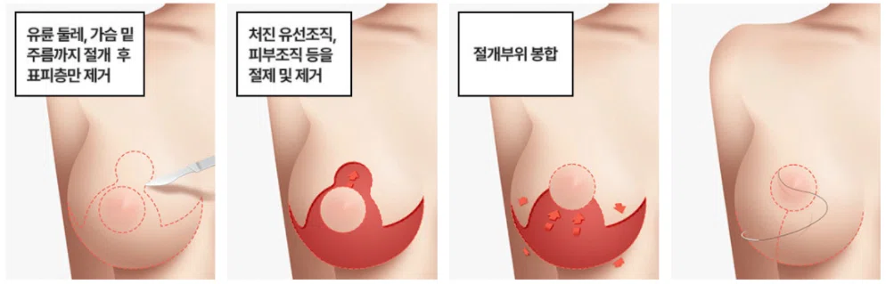 韓国整形 豊胸 谷間 バストアップ 垂れ乳