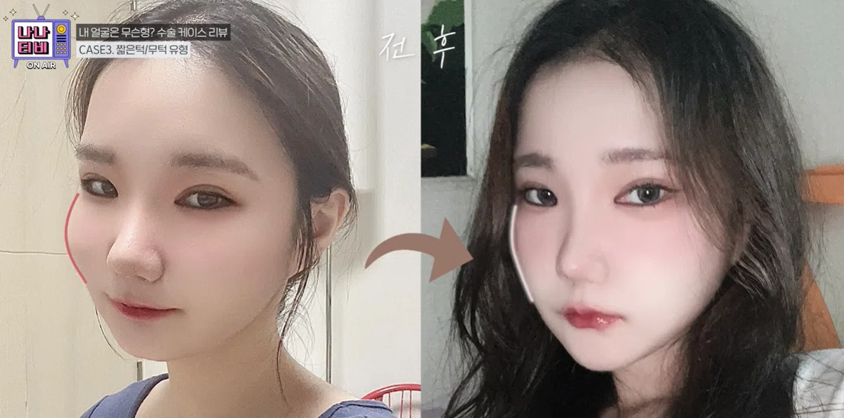 韓国整形　輪郭整形　輪郭3点　韓国美容外科