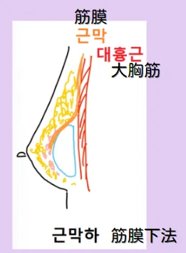 韓国整形 豊胸 谷間 バストアップ 垂れ乳