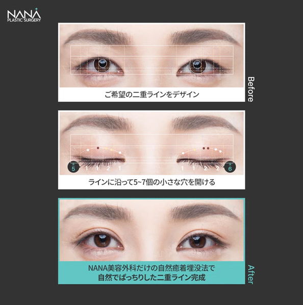 二重整形　二重埋没　自然癒着法　二重ライン　目整形