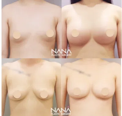 韓国整形 豊胸 谷間 バストアップ 垂れ乳