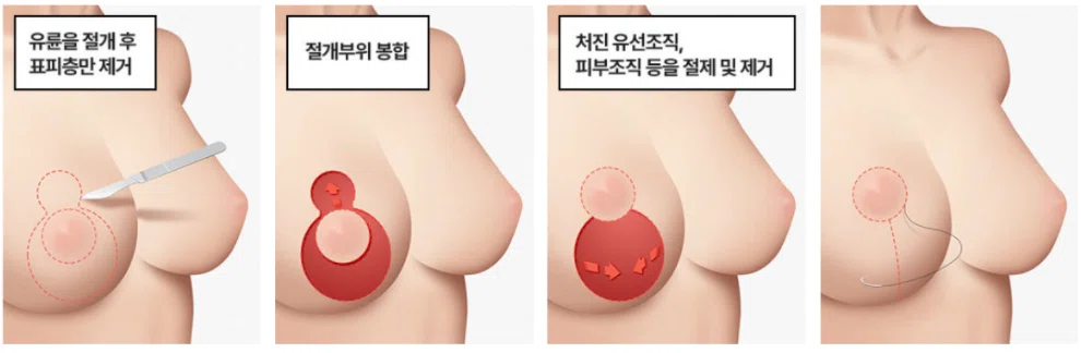 韓国整形 豊胸 谷間 バストアップ 垂れ乳