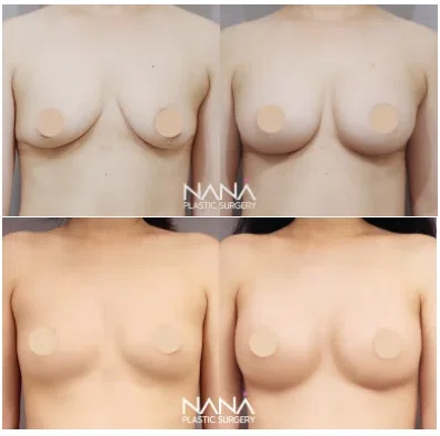 韓国整形 豊胸 谷間 バストアップ 垂れ乳