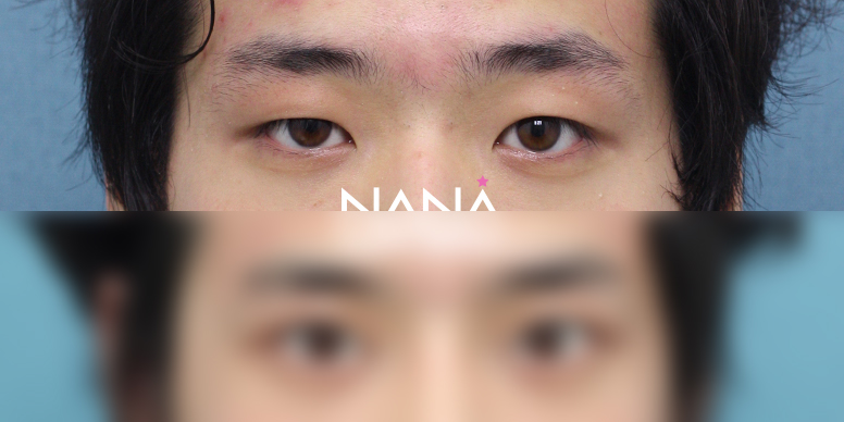 남자성형 전후사진 — 전후사진