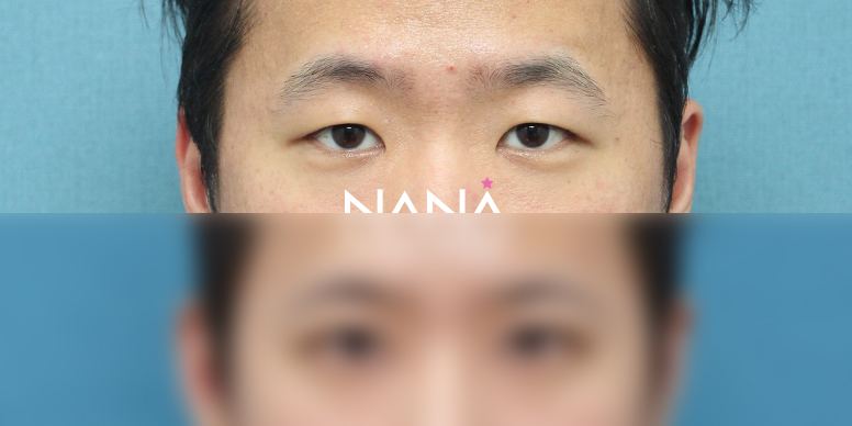 남자성형 전후사진 — 전후사진