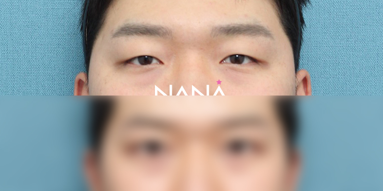 남자성형 전후사진 — 전후사진
