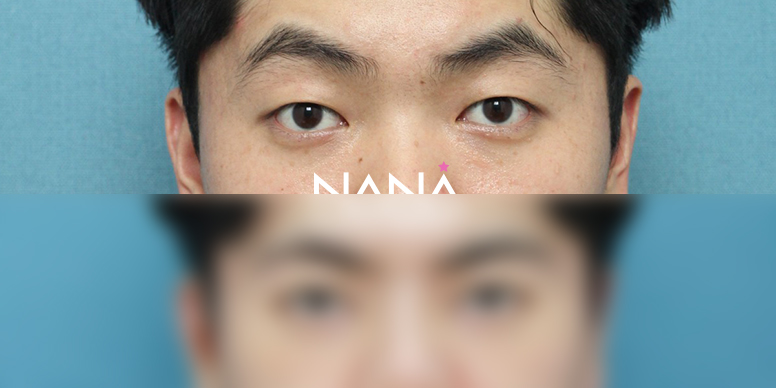 남자성형 전후사진 — 전후사진