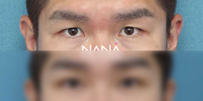 남자성형 전후사진 — 전후사진