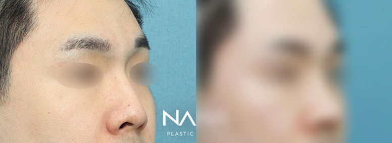 남자성형 전후사진 — 전후사진