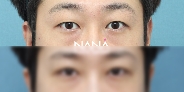 남자성형 전후사진 — 전후사진