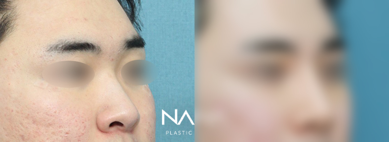 남자성형 전후사진 — 전후사진