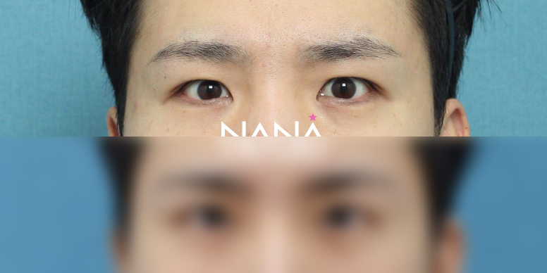 남자성형 전후사진 — 전후사진