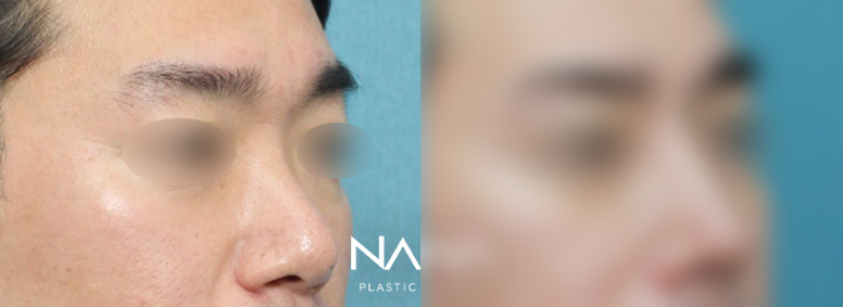 남자성형 전후사진 — 전후사진