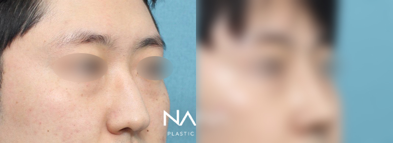 남자성형 전후사진 — 전후사진