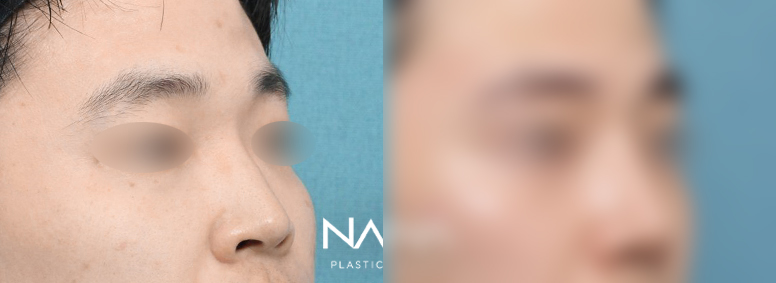 남자성형 전후사진 — 전후사진